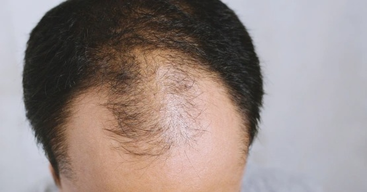 Rụng tóc nhiều có phải là dấu hiệu bị ung thư hay không?