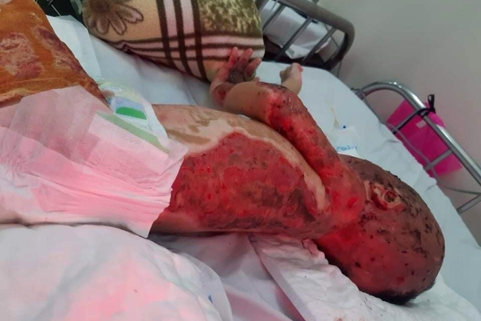 Đau nhói lòng cảnh cậu bé 2 tuổi bị bỏng xăng nặng do chơi trò sinh nhật - 3 Đau nhói lòng cảnh cậu bé 2 tuổi bị bỏng xăng nặng do chơi trò sinh nhật - 3