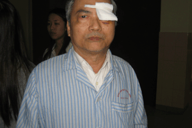 Mù vĩnh viễn vì chủ quan với bệnh Glôcôm