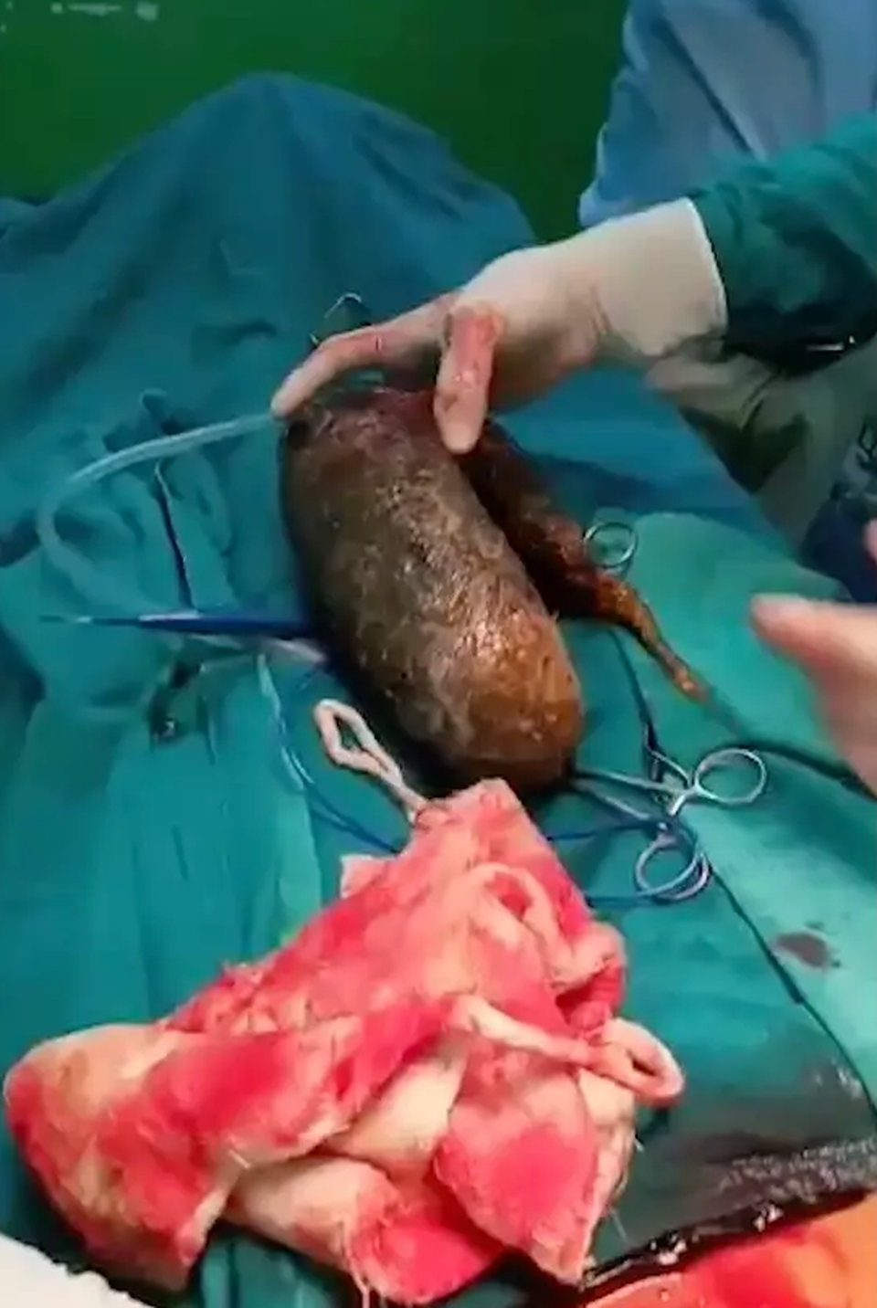 Loại bỏ khối u tóc gần 7 kg trong bụng cô gái trẻ - 2 Loại bỏ khối u tóc gần 7 kg trong bụng cô gái trẻ - 2