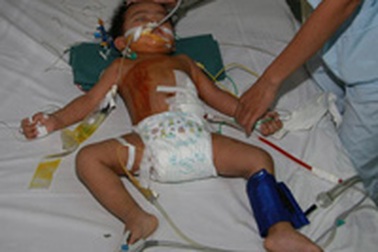 Ghép thận tự thân cho bệnh nhi 28 tháng tuổi 