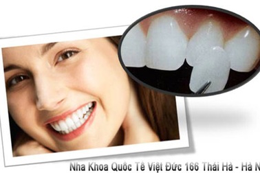 Tái tạo nụ cười với răng sứ Veneer