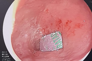 Quên bóc vỉ thuốc trước khi uống, nữ bệnh nhân 65 tuổi phải nhập viện