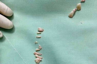 Bóc khối u hàm dưới, phát hiện 30 chiếc răng ở bên trong