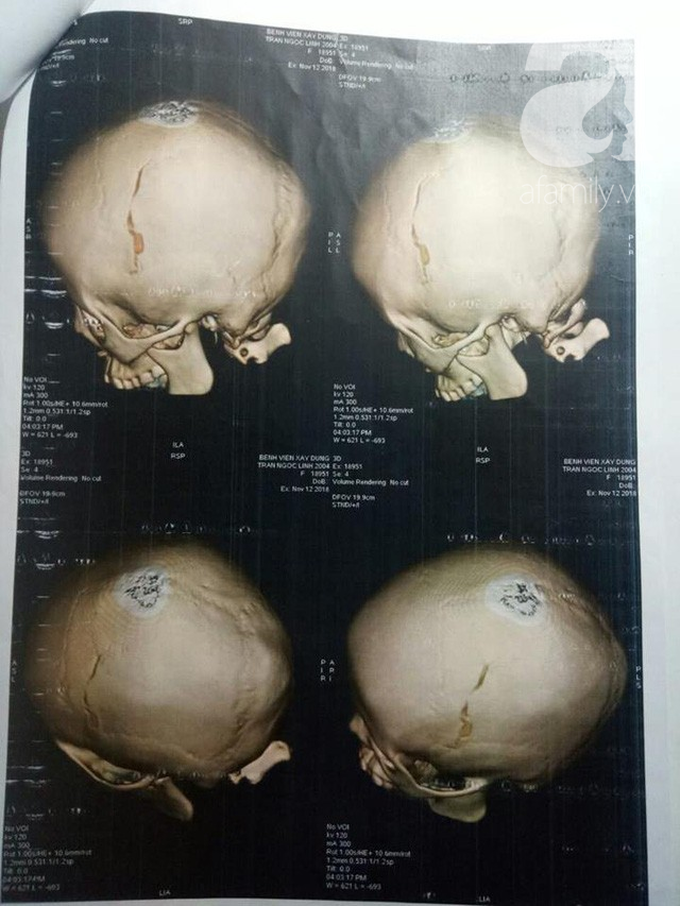 Nữ sinh lớp 9 tố bị vợ 2 của bố đánh chấn thương phải lưu ban do nghỉ quá số ngày quy định - Ảnh 4. Nữ sinh lớp 9 tố bị vợ 2 của bố đánh chấn thương phải lưu ban do nghỉ quá số ngày quy định - Ảnh 4.