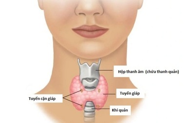 Khàn tiếng, nuốt vướng cảnh báo ung thư tuyến giáp