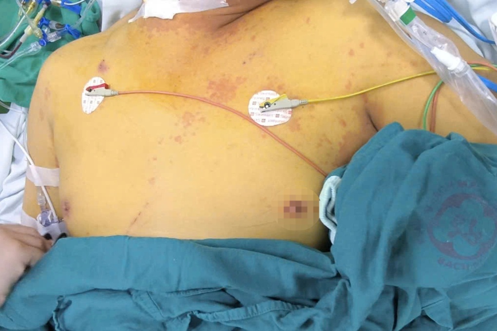 Nhiều ca suy gan, suy thận vì loại vi khuẩn trong nước lũ - 2 Nhiều ca suy gan, suy thận vì loại vi khuẩn trong nước lũ - 2