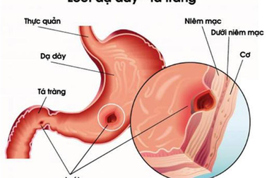 Những nguy hiểm từ bệnh viêm loét dạ dày - tá tràng