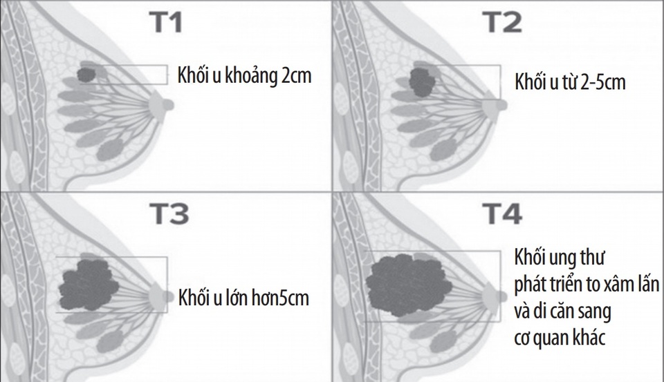 Phân biệt u vú lành tính và ung thư vú - 1 Phân biệt u vú lành tính và ung thư vú - 1