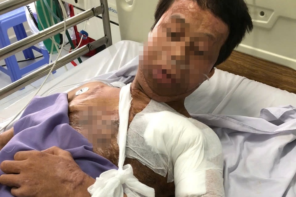 Chàng trai hóa “ngọn đuốc sống” vì hút thuốc khi đổ xăng, đi mổ hơn 20 lần - 2 Chàng trai hóa “ngọn đuốc sống” vì hút thuốc khi đổ xăng, đi mổ hơn 20 lần - 2