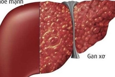 Bị nhiễm virus viêm gan B, có lo ngại tiến triển ung thư?