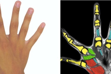 Có 6 ngón tay không vô dụng như các bác sĩ từng nghĩ