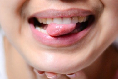 Giật mình tưởng bị nhiệt miệng hóa ra mắc ung thư lưỡi