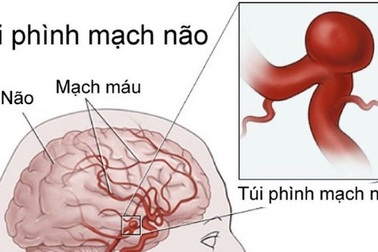 Nguy cơ phình mạch máu do sử dụng thuốc ung thư