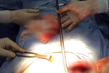 Cứu sống bệnh nhân bị thanh sắt xuyên thủng ngực