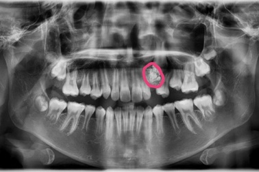 Lý do bất ngờ khiến bé gái 12 tuổi chưa mọc răng nanh