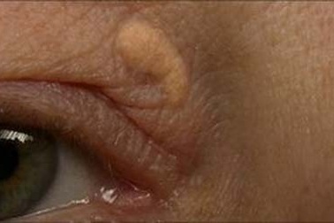 Nhìn mí mắt đoán nguy cơ đau tim