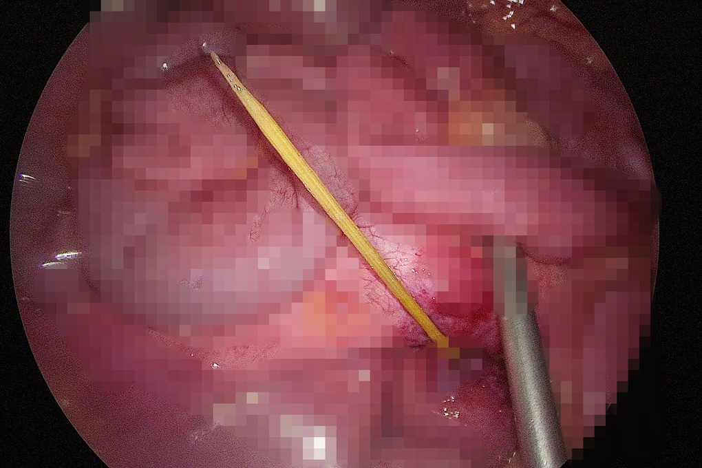 Bé trai 14 tuổi lâm nguy vì tai nạn khi vừa ăn, vừa uống nước - 2 Bé trai 14 tuổi lâm nguy vì tai nạn khi vừa ăn, vừa uống nước - 2
