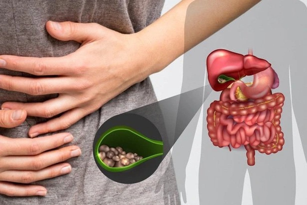 Siêu âm phát hiện polyp trong túi mật: Có nguy cơ ung thư? - 1 Siêu âm phát hiện polyp trong túi mật: Có nguy cơ ung thư? - 1
