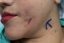 Người phụ nữ từ Hà Nội vào TPHCM cầu cứu vì gò má bỗng dưng chảy mủ