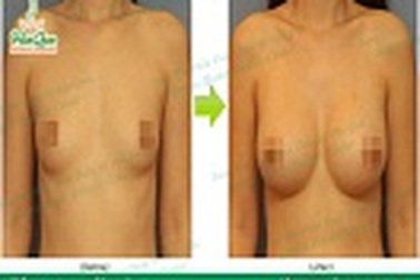 Nâng ngực nội soi công nghệ mới từ Thẩm mỹ Hàn Quốc