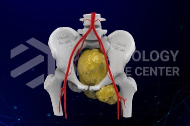 Ca phẫu thuật loại bỏ khối ung thư xương trên 20cm