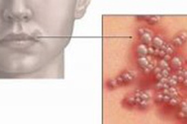 Điều trị mụn rộp