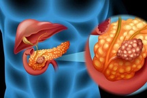 Căn bệnh ung thư tụy cố nhạc sĩ Phó Đức Phương mắc phải nguy hiểm thế nào?