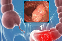 Chuyên gia chỉ rõ các dấu hiệu nguy cơ ung thư đại trực tràng