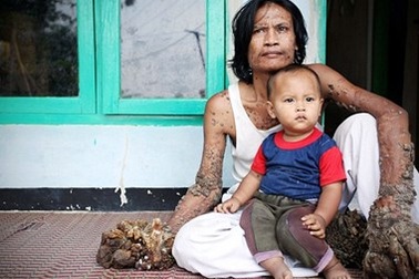 “Người cây” Indonesia qua đời khi chưa được làm thợ mộc