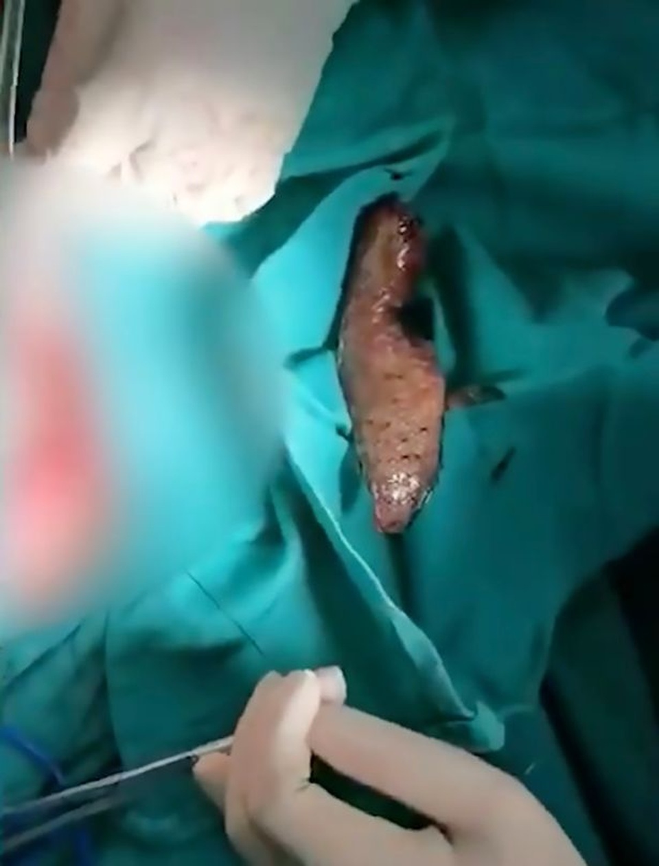 Kinh hoàng phát hiện “nguyên con cá rô phi trong bụng” - 3 Kinh hoàng phát hiện “nguyên con cá rô phi trong bụng” - 3