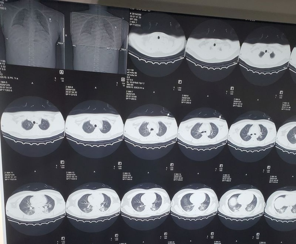 Hành trình thoát “cánh cửa tử thần” của bệnh nhân nhiễm virus corona - 2 Hành trình thoát “cánh cửa tử thần” của bệnh nhân nhiễm virus corona - 2