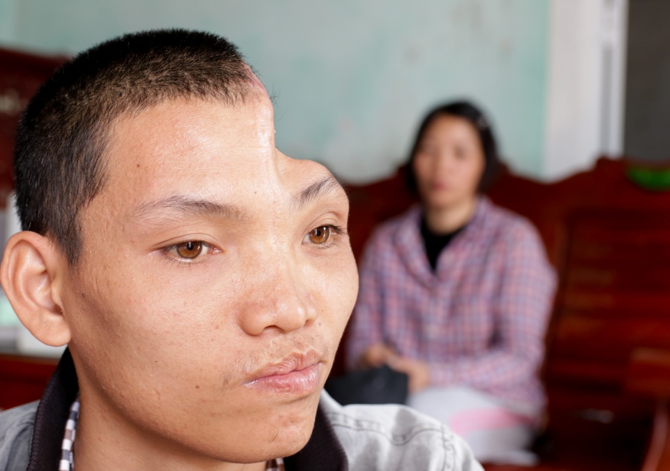 Được bạn đọc giúp đỡ, người mẹ bán rau vui mừng chờ ngày ghép sọ cho con - 2 Được bạn đọc giúp đỡ, người mẹ bán rau vui mừng chờ ngày ghép sọ cho con - 2