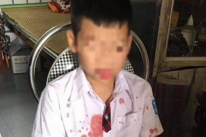 Bênh con, phụ huynh vào trường đánh trẻ lớp 1 đến nhập viện