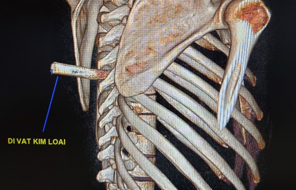 Nam thanh niên nhập viện với mũi dao đâm thẳng vào sống lưng - 1 Nam thanh niên nhập viện với mũi dao đâm thẳng vào sống lưng - 1