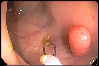 5 dấu hiệu giúp tự nhận biết sớm ung thư đại trực tràng