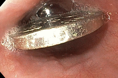 Ngậm đồng xu 200 đồng, bé trai 6 tuổi suýt chết