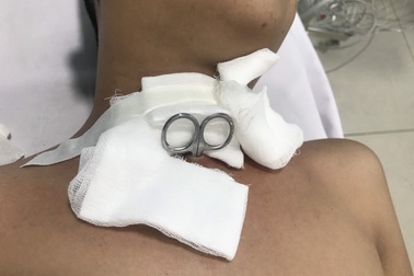 Tự gây thương tích, bệnh nhân nhập viện với cây kéo đâm xuyên cổ