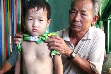 Nỗi bất hạnh của gia đình có con chết đuối, con bệnh nặng