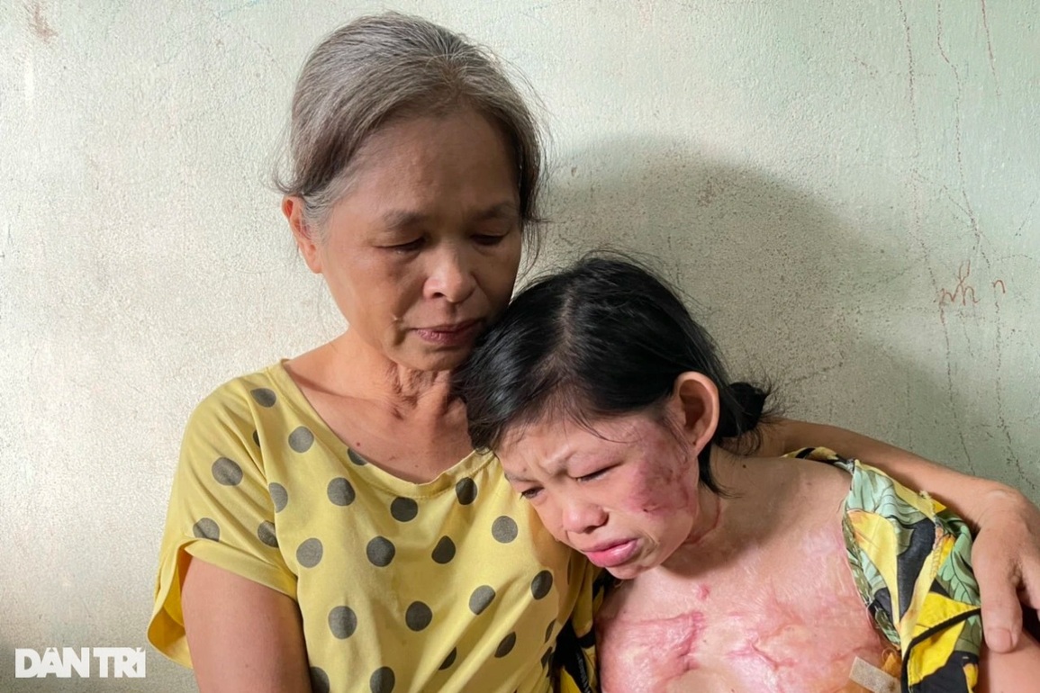 Bạn đọc Dân trí giúp đỡ người mẹ góa nuôi con bị bỏng gần 230 triệu đồng - 2 Bạn đọc Dân trí giúp đỡ người mẹ góa nuôi con bị bỏng gần 230 triệu đồng - 2