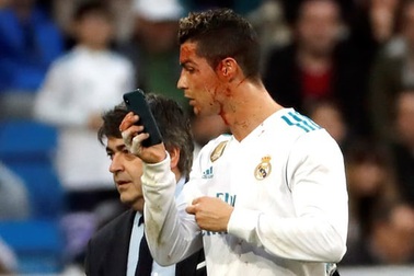 Chảy máu đầm đìa, C.Ronaldo mượn điện thoại kiểm tra vết thương