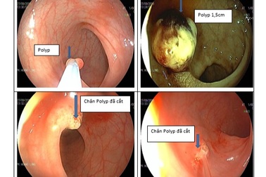 Nhận biết dấu hiệu polyp đại tràng như thế nào?