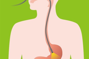Nội soi tiêu hóa trên: Bước đơn giản để phát hiện ung thư
