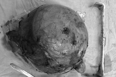 Khối u xơ tử cung nặng gần 6kg sau 3 năm