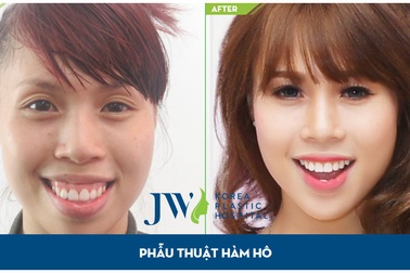 Phẫu thuật hàm hô, móm - cuộc đời nở hoa hay cuộc sống bế tắc?