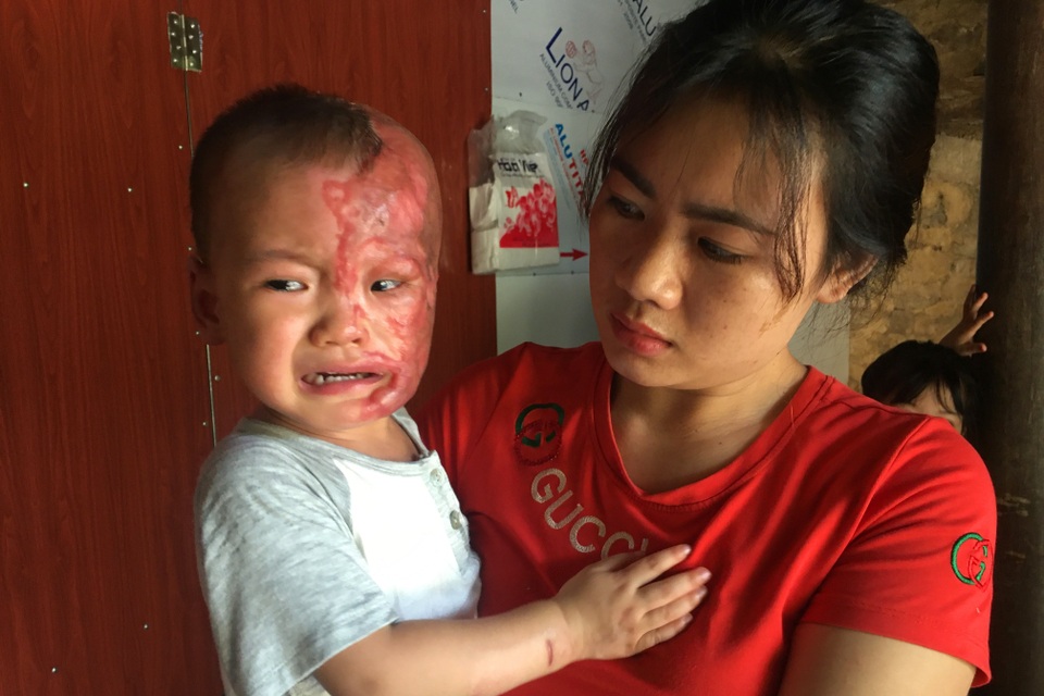 Đau nhói lòng cảnh cậu bé 2 tuổi bị bỏng xăng nặng do chơi trò sinh nhật - 5 Đau nhói lòng cảnh cậu bé 2 tuổi bị bỏng xăng nặng do chơi trò sinh nhật - 5