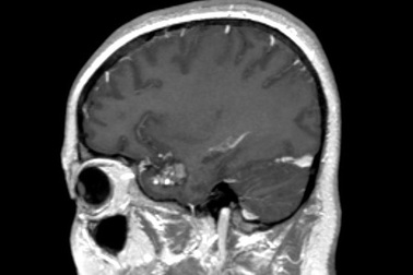 Lần đầu xạ phẫu u mạch hang ở não bằng máy xạ trị gia tốc hiện đại