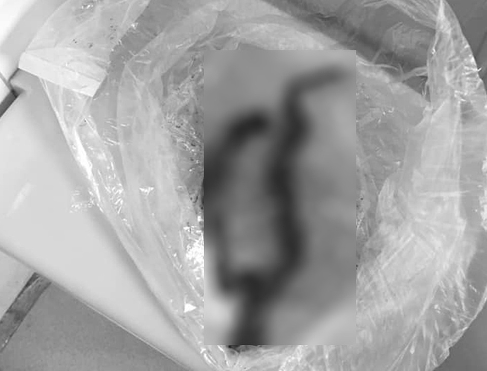 Người đàn ông được đưa đến bệnh viện cùng… 1 đoạn ruột đựng trong túi bóng - 2