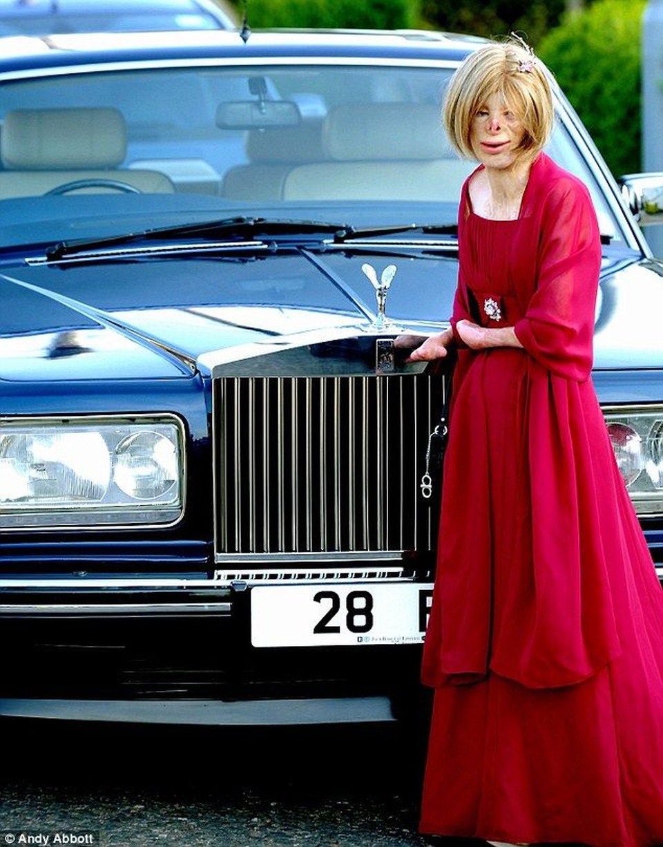 Hạnh phúc bất ngờ của cô gái từng bị bỏng đến biến dạng - 4