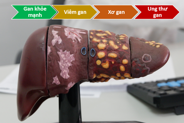 Mắc viêm gan B mạn tính ảnh hưởng đến cơ thể như thế nào?